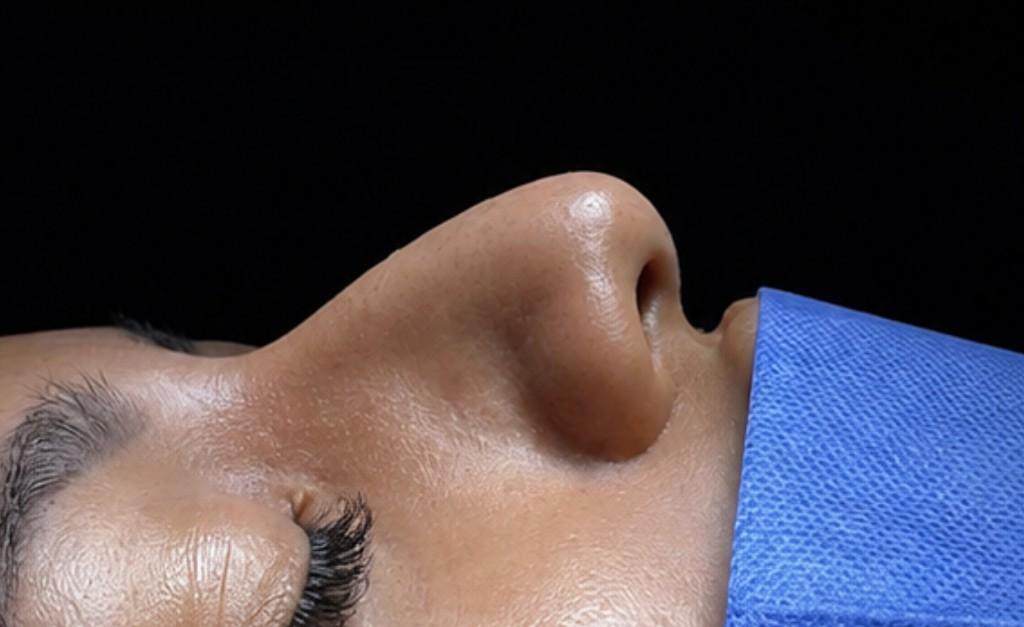 Caso de rinoplastia — antes